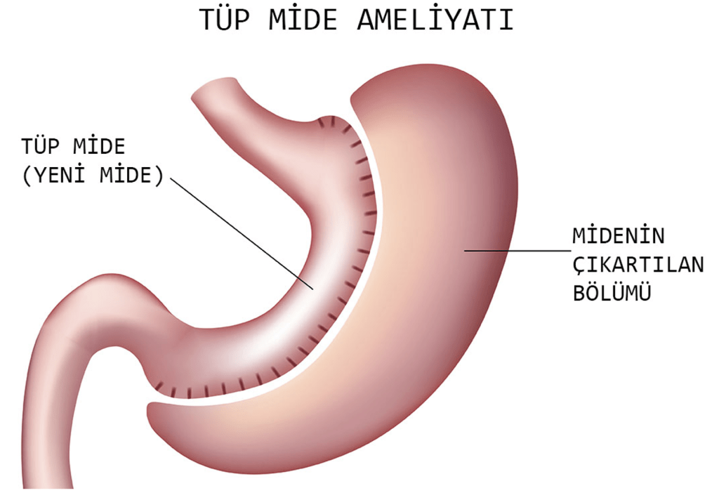 Tüp Mide Ameliyatı