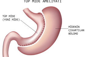 Tüp Mide Ameliyatı
