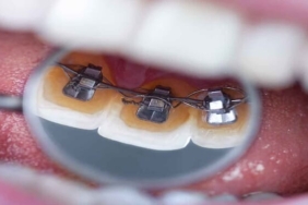 Ortodontide Sık Sorulanlar