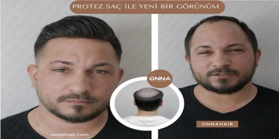 Protez Saç ile Yeni Bir Görünüm