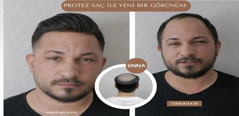 Protez Saç ile Yeni Bir Görünüm