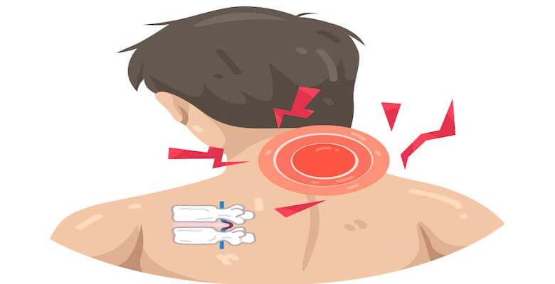 Boyun Fıtığı Ameliyatı: Ne Zaman Gerekir, Hangi Yöntemler Uygulanır?